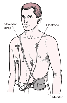 Holter Monitor